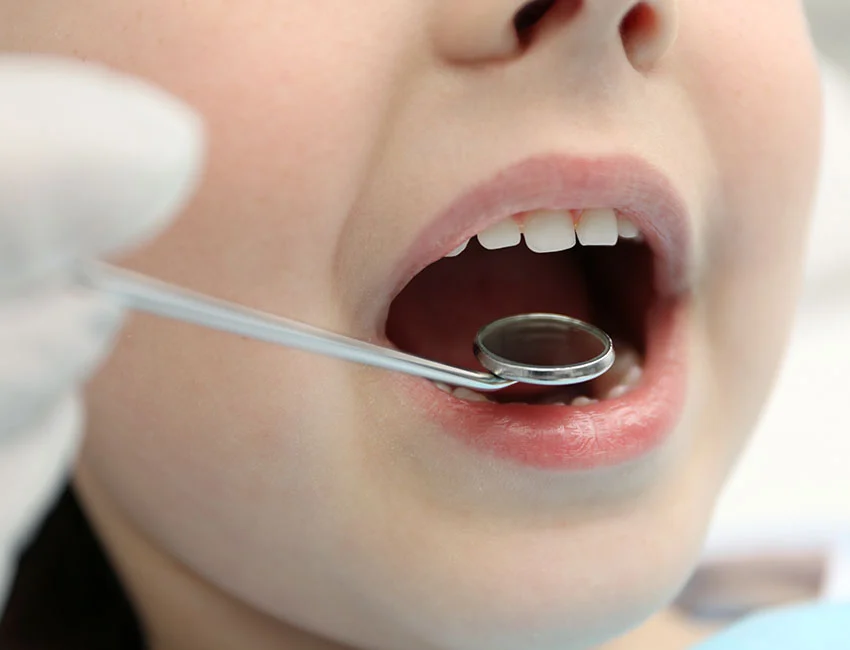 What is Dental Sealants