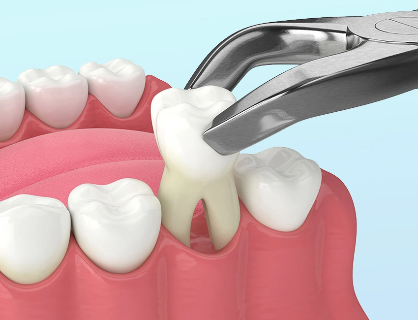 What is Tooth Extraction