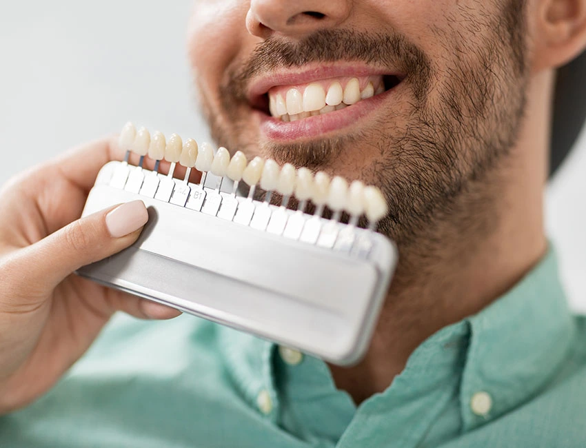 Dental veneers on the front teeth
