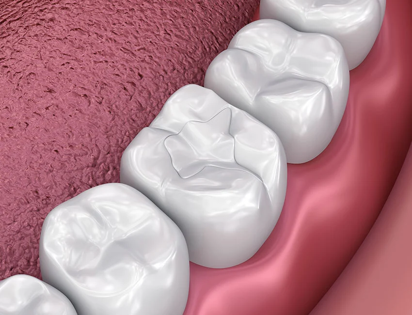 What is Dental Fillings
