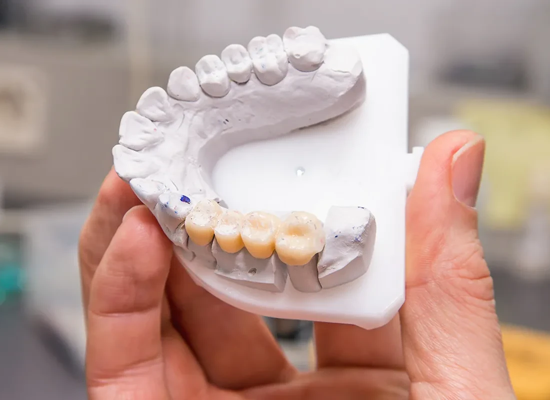Dental Bridge at Gardena Dental Group
