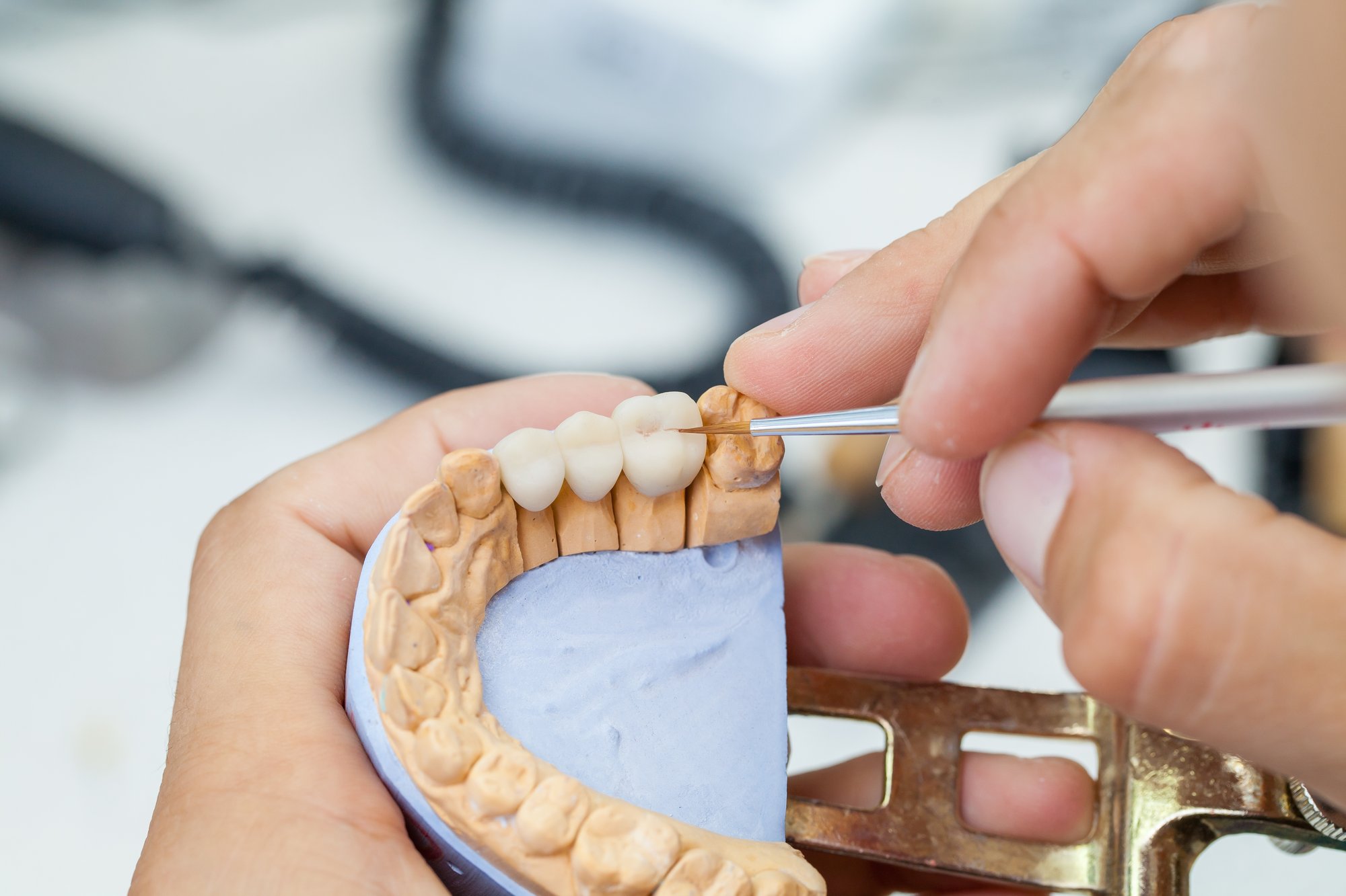dental bridge construction