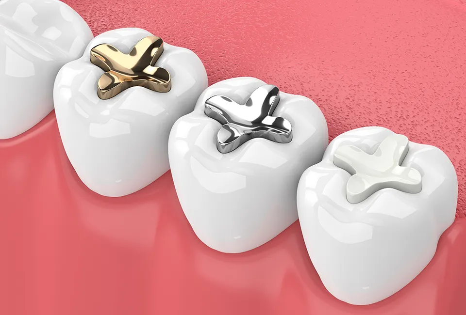 dental fillings