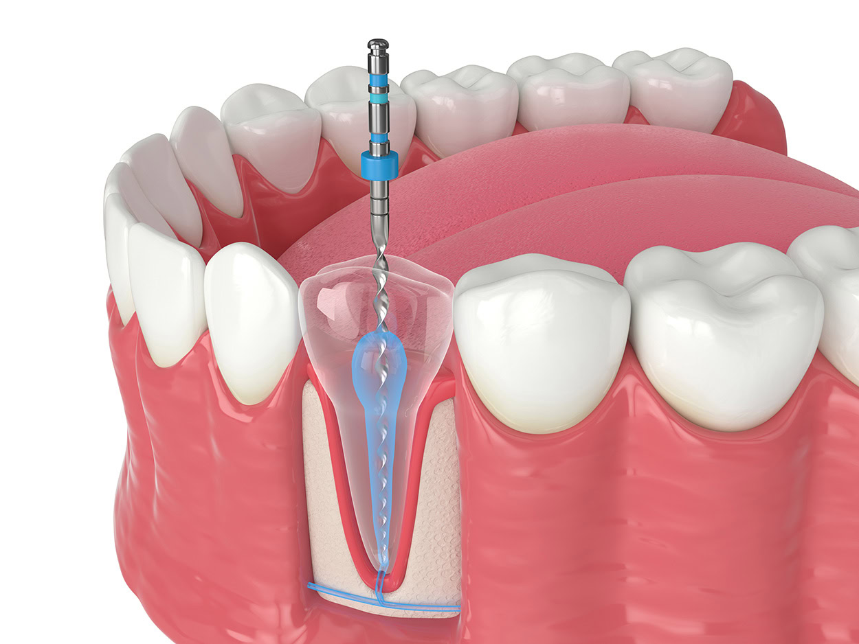 root canal