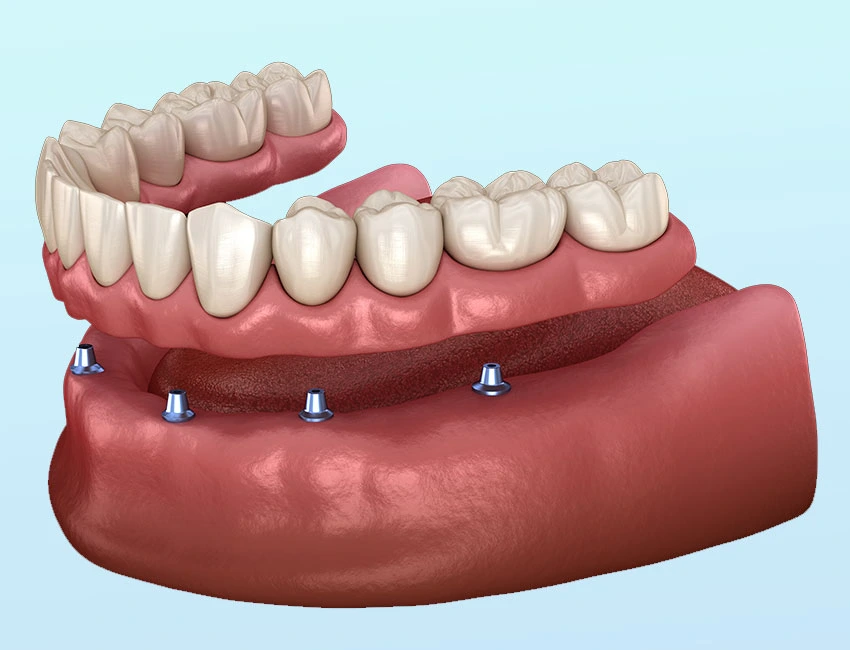 What is Implant-Supported Dentures