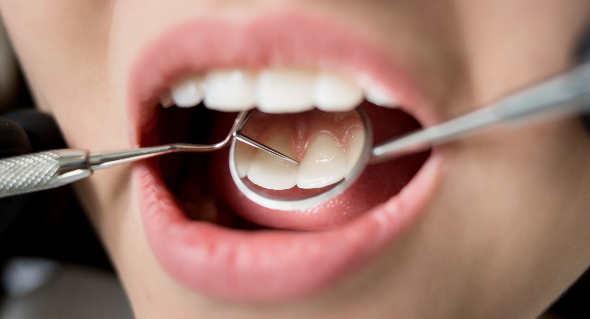 gum disease patient