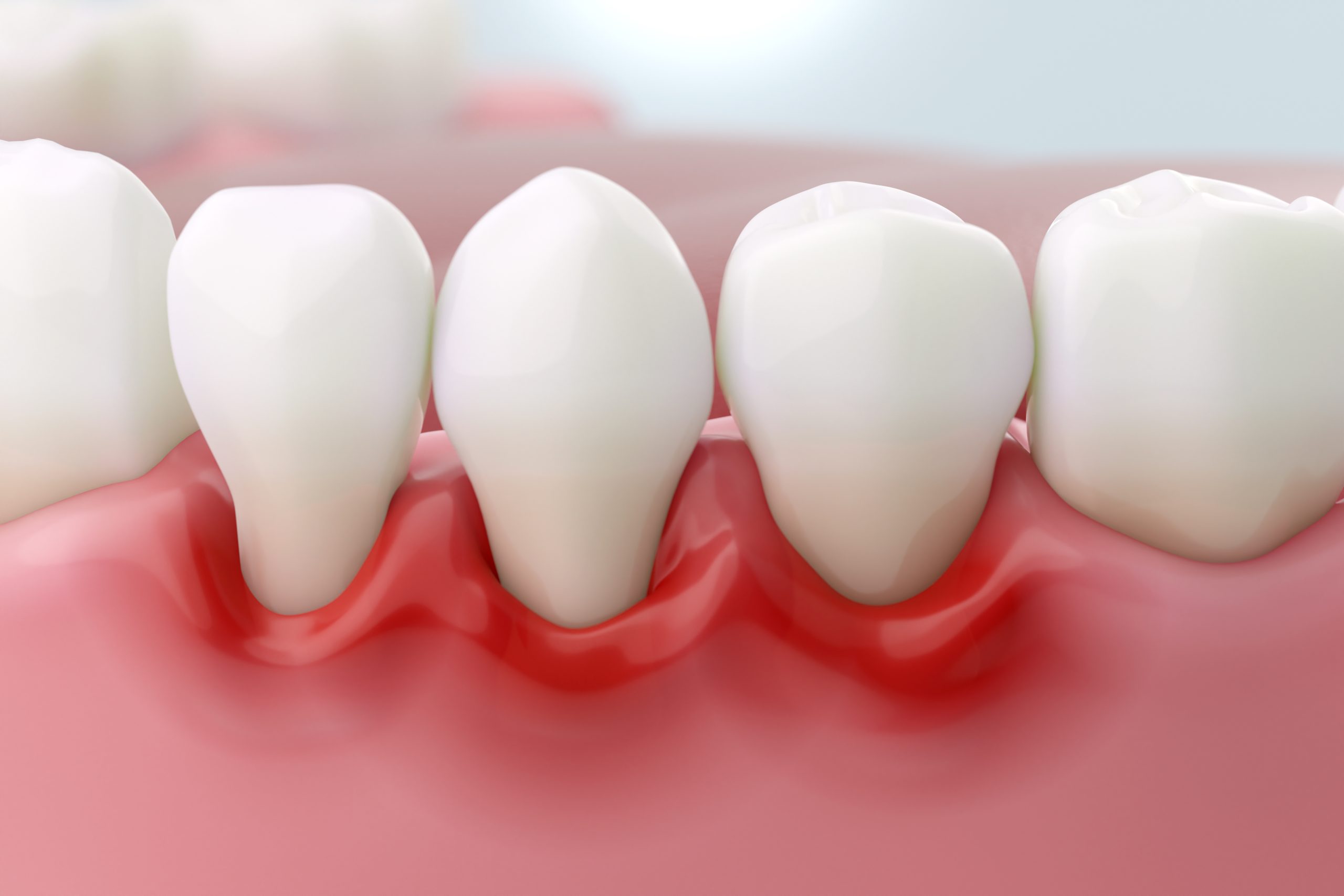 gum disease model