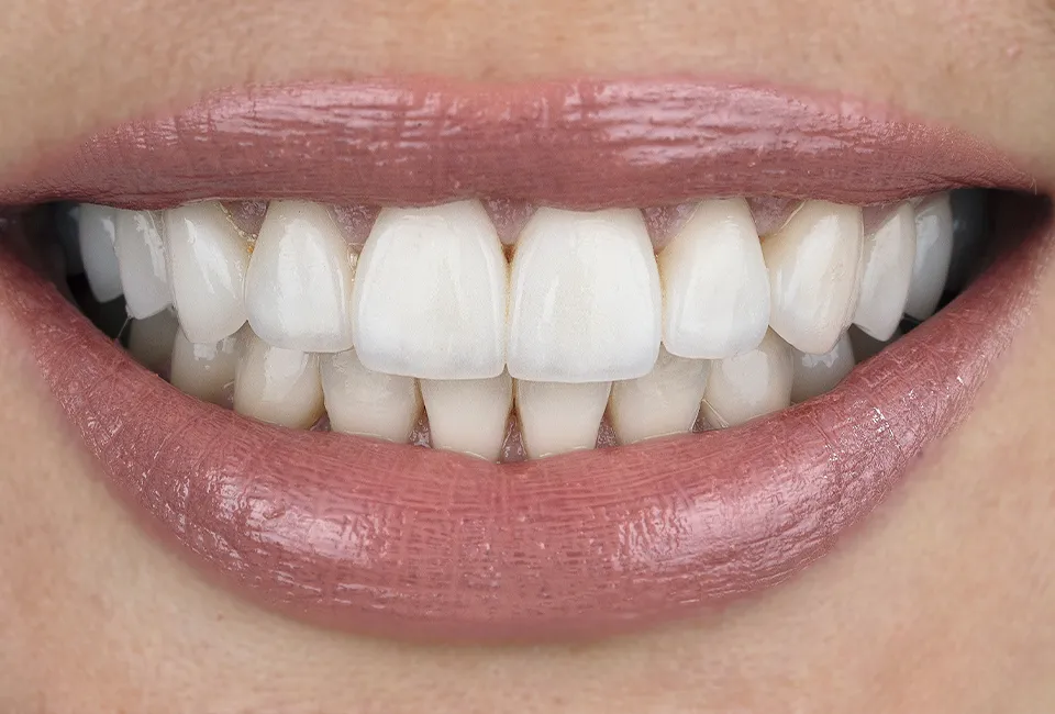 Dental Veneers and Laminates in Gardena, CA