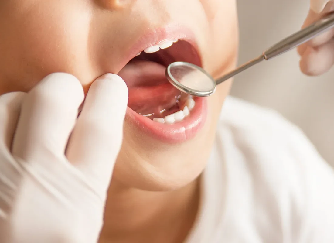 Fluoride Treatments in Gardena, CA