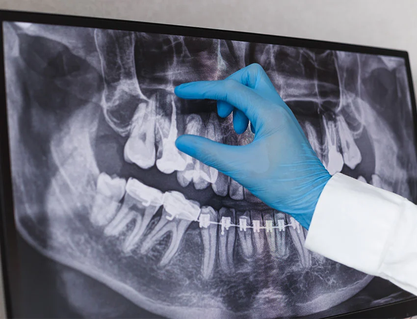 What is Root Canal Treatment