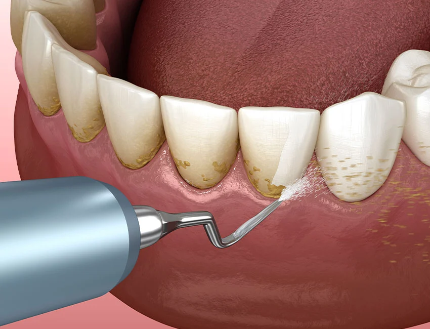 What is Teeth Cleaning
