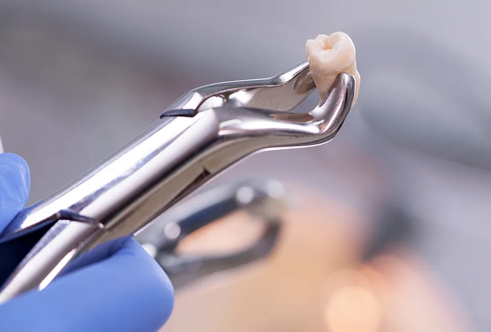 Tooth extraction in Gardena