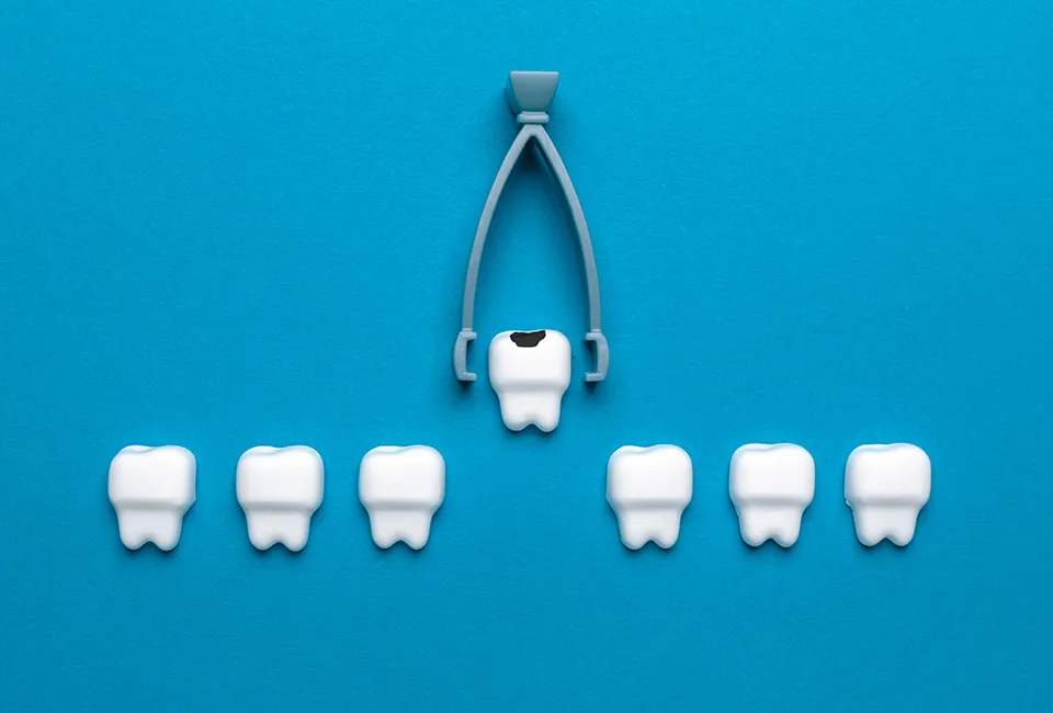 Tooth extraction in Gardena, CA