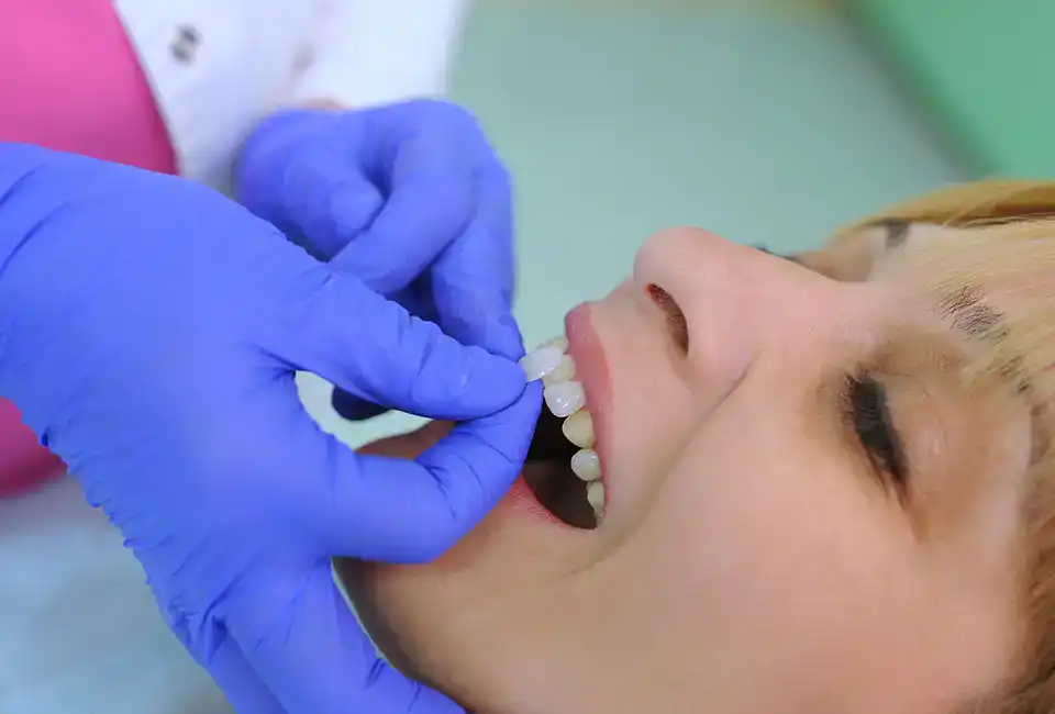 dental veneers