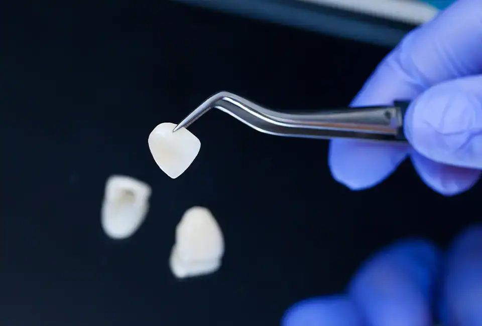 I want dental veneers