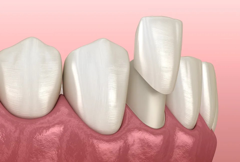dental veneers in gardena