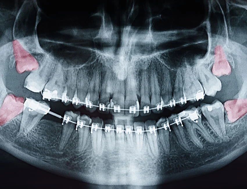 What is Wisdom Teeth Removal